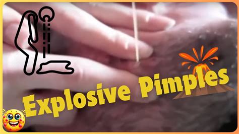 pimple popping youtube